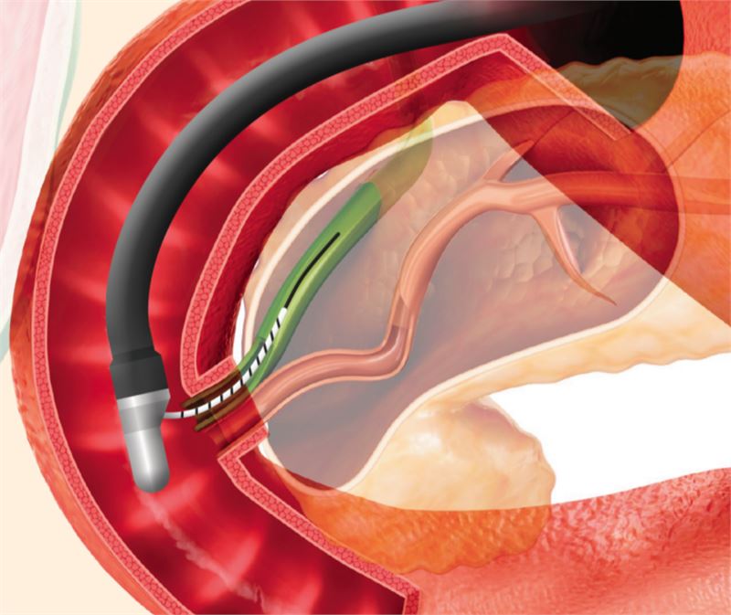 성원메디칼, ERCP Guide Wire ‘TRU WIRE’ 수출 확대 안티에이징뉴스